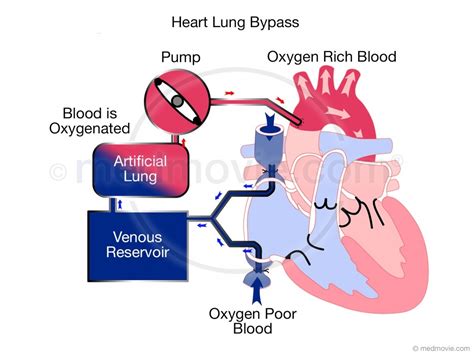 centrifugal pump cardiopulmonary bypass|what is a cardiopulmonary bypass.